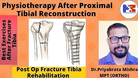 Physiotherapy after Proximal Tibial Reconstruction. Exercises after Proximal Tibia Nailing /Plating