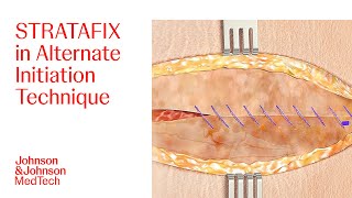 Stratafix Symmetric Pds Plus Alternate Initiation Suturing Technique Jj Medtech