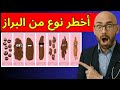 أخطر نوع من البراز إذا رأيته لا تتجاهله أبدا 