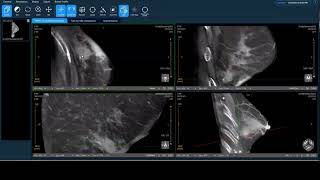 Koning Health Case Overview Small Breast, Idc