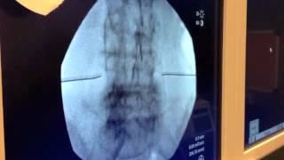 Watch This Bilateral Transforaminal Injection Live by Dr. McJunkin