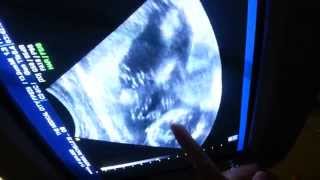 VASH @ 4 MONTHS IN THE WOMB