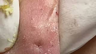 Loan Nguyen Acne Treatment 0093