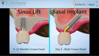 Sinus Lift or Basal Implant © 3D Animation video