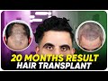 Hair transplant in india  best results  cost of hair transplant in india