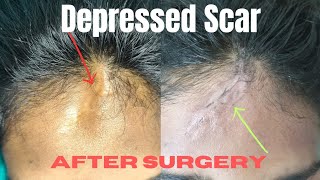 Depressed scar on forehead - Change after surgery| Best Scar revision surgery| #scartreatment