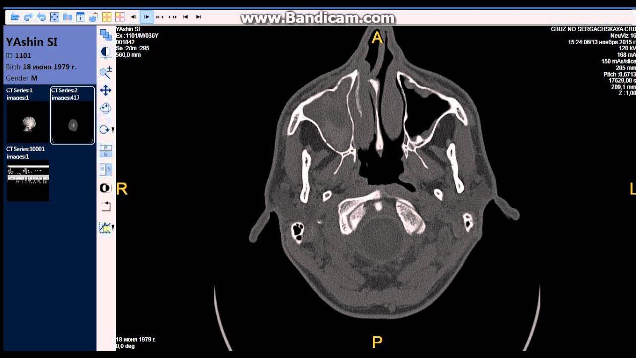 Кт снимок пазух носа. Кт придаточных пазух носа. Кт гайморовых пазух норма. Одонтогенная киста верхнечелюстной пазухи кт. Хронический полипозный риносинусит кт.