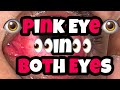 VLOG: PINK EYE IN BOTH EYES | Blocked On Facebook | What I Did On My Birthday | Brand New Face Tat |