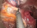 Transanal minimally invasive surgery tamis resection of early rectal cancer