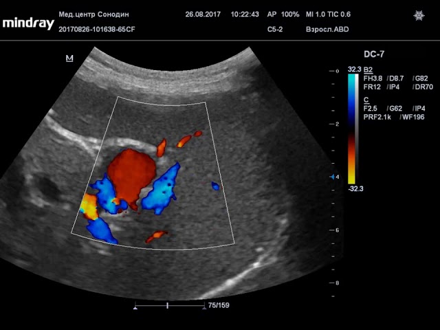 Аневризма селезеночной артерии