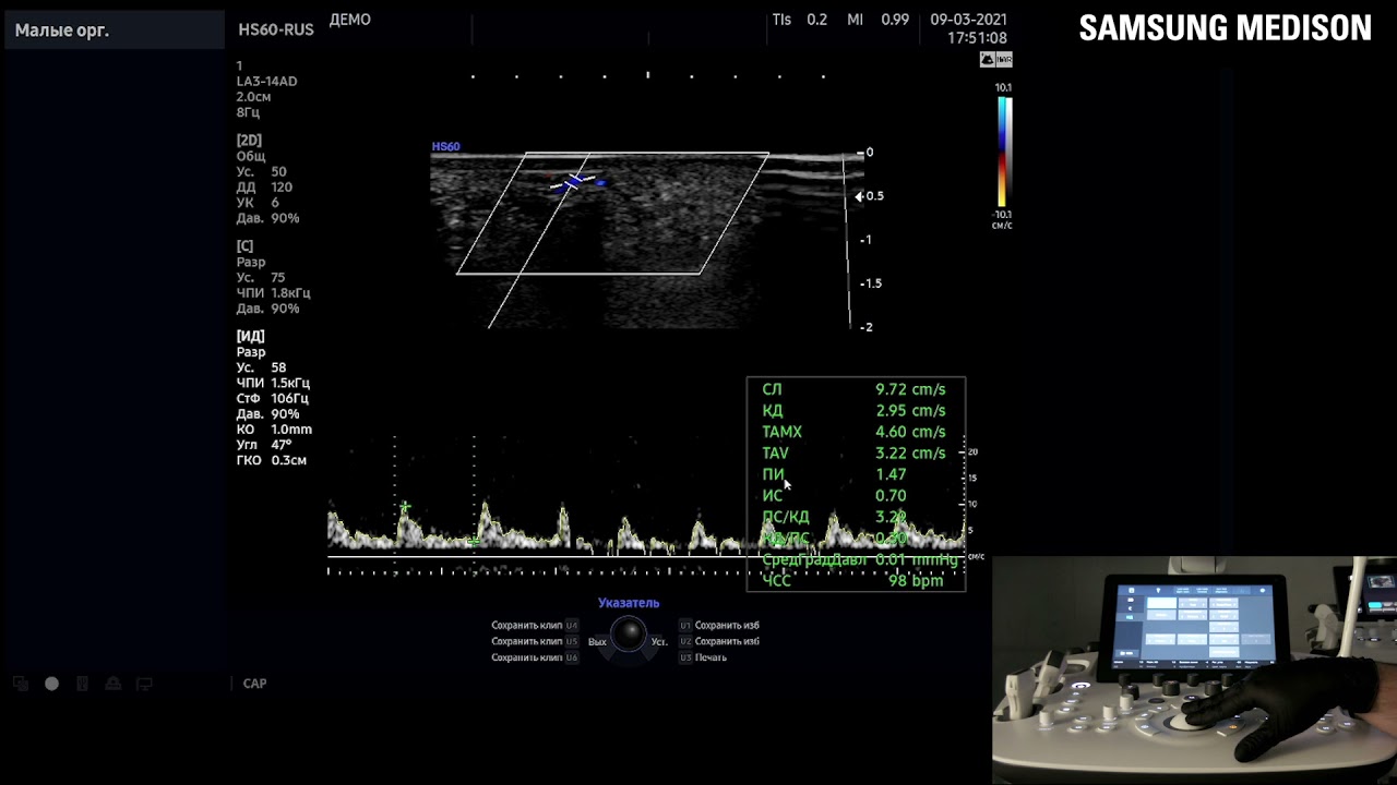 Настройка и регулировка импульсного доплера на УЗ сканере HS60 Samsung Medison.