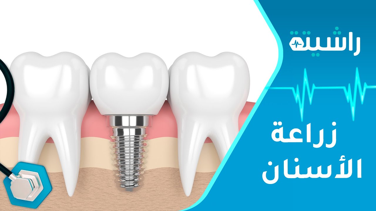 ما أسباب فشل زراعة الأسنان؟ | راشيتة