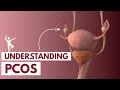 Understanding pcos  3d animation