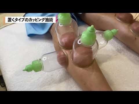 足裏のつぼに吸い玉をしてむくみや疲労・冷え症を改善！悩む女性の体験談とビフォーアフター