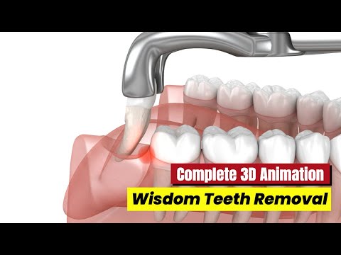 🦷 Wisdom Teeth Removal Animation | Complete 3D Surgical Procedure Explained