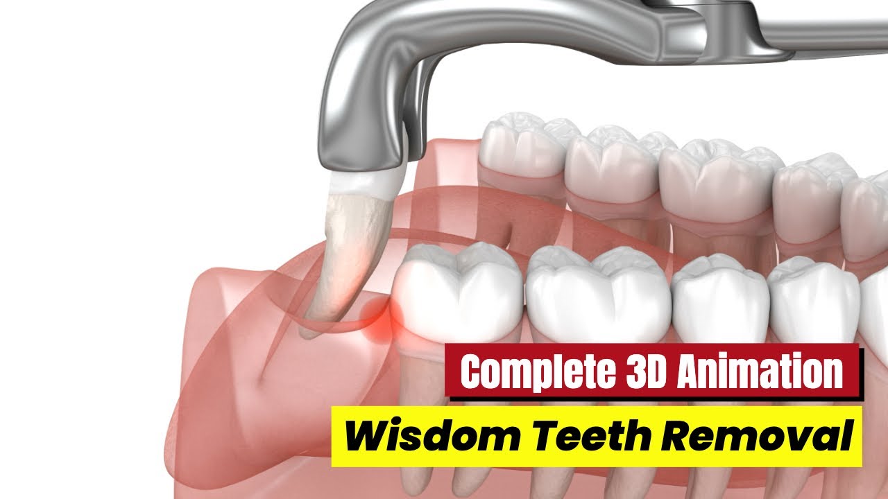 🦷 Wisdom Teeth Removal Animation | Complete 3D Surgical Procedure Explained