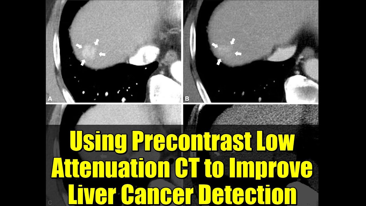 Using Precontrast Low Attenuation CT to Improve Liver Cancer Detection | LI-RADS Insights