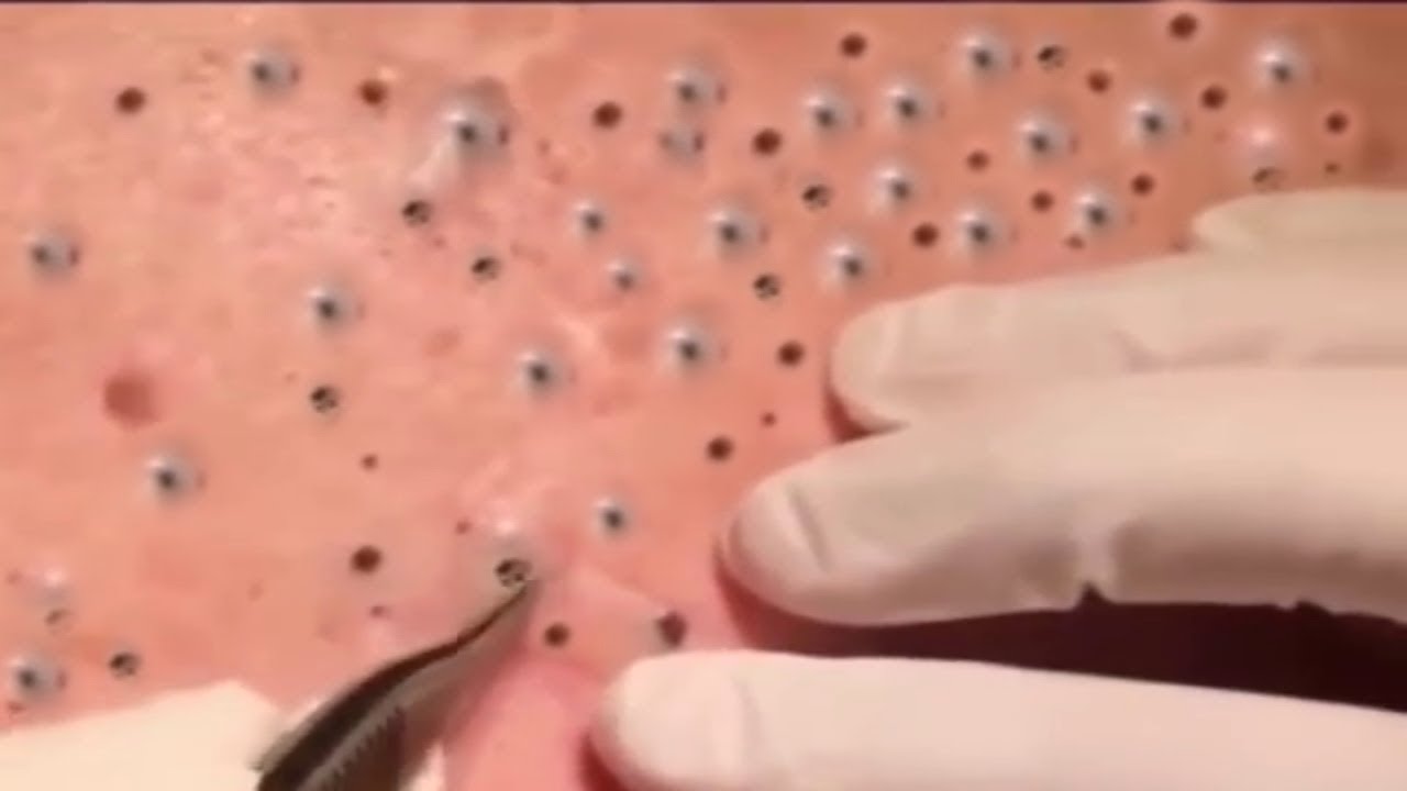 How to Removal Blackheads,Whiteheads #44 - YouTube