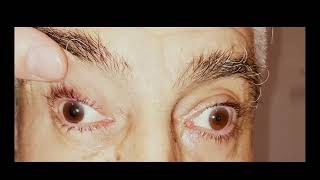 Casos Clínicos Semio Neurológica