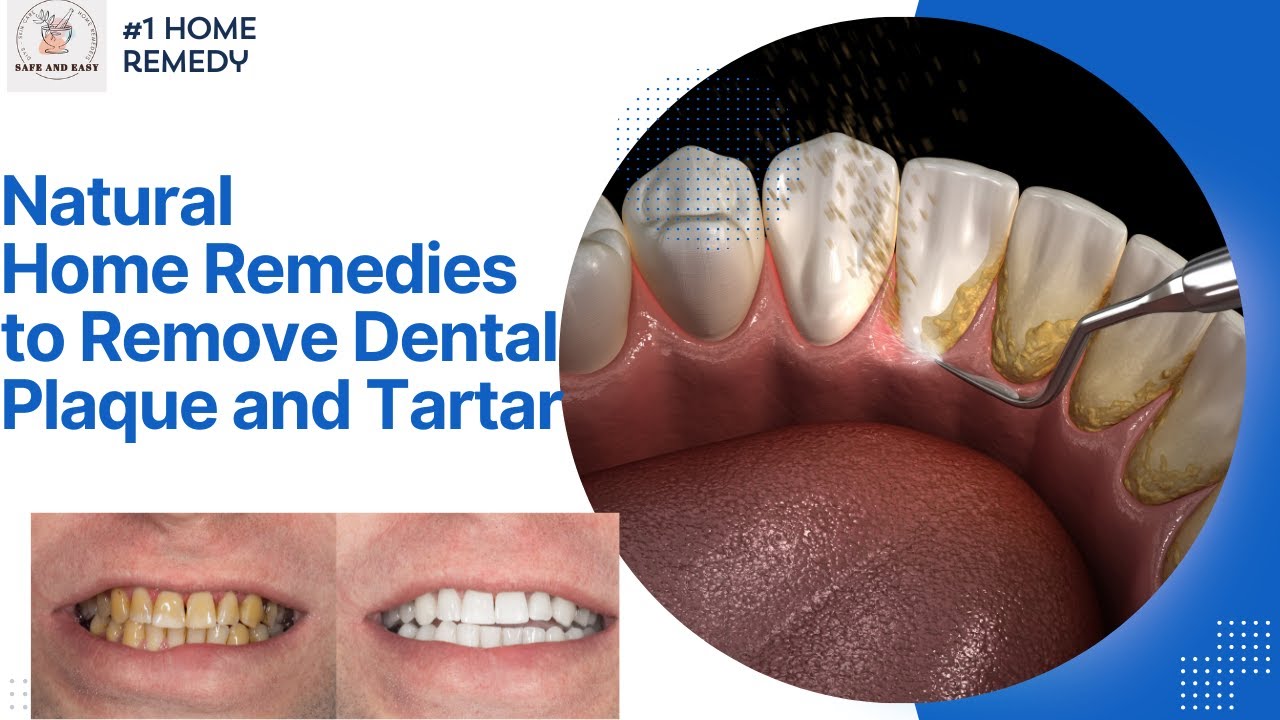 "Natural Home Remedies to Remove Dental Plaque and Tartar Your Key to