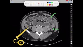 Sample from last year's 1st CCC Radiology for Surgeons - CECT Bowel Obstruction - Join us this week!
