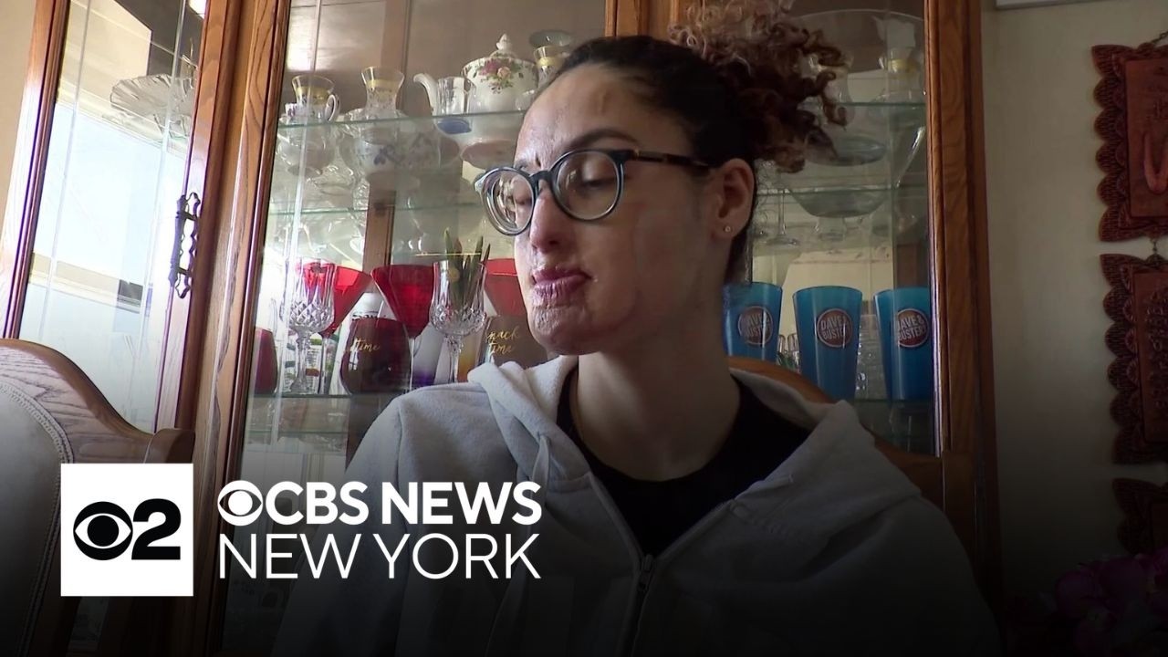 Live: Arrest made in Long Island acid attack that left college student disfigured.