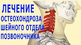 ★Как лечить ОСТЕОХОНДРОЗ ШЕЙНОГО ОТДЕЛА позвоночника. Медикаментозное лечение, гели и мази. ★Как лечить ОСТЕОХОНДРОЗ ШЕЙНОГО ОТДЕЛА позвоночника. Медикаментозное лечение, гели и мази.