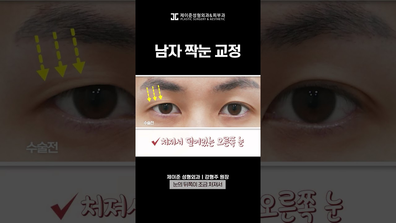 [JAYJUN PHẪU THUẬT THẨM MỸ DA] Nỗi lo mắt hai mí không đều của nam giới! Giải quyết như thế này nhé! #shorts