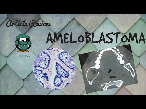 Video: Ameloblastoma: Sintomi, Trattamento, Forme, Stadi, Diagnosi