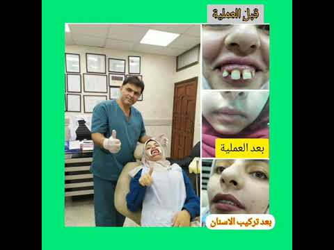 علاج تشوة وبروز الفك العلوي صور توضح قبل وبعد