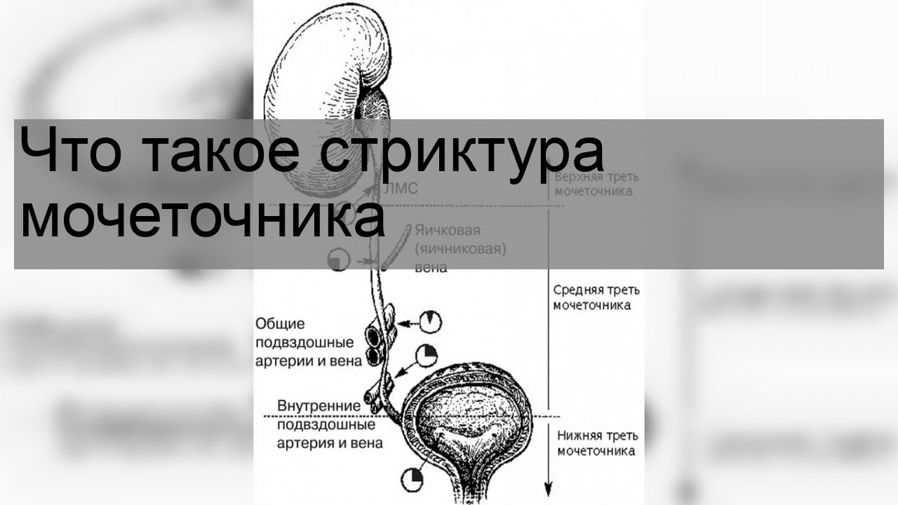 Что такое стриктура мочеточника