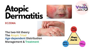Eczema (Atopic Dermatitis) | Atopic Triad, Triggers, Who gets it, Why does it happen, & Treatment