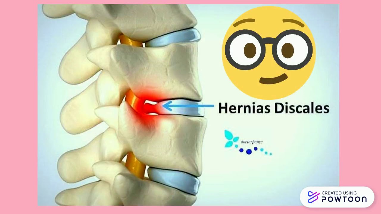 Que Es Una Hernia Discal Cuales Son Sus Causas Dr Alfonso Vega Images