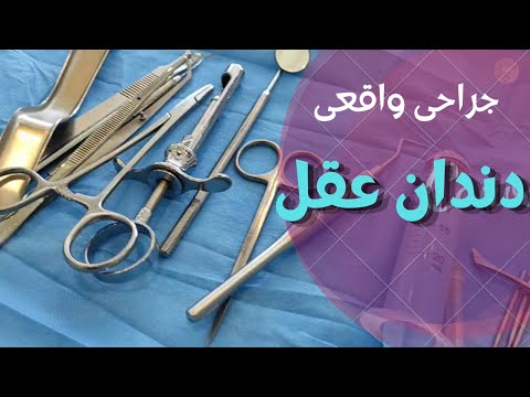 جراحی واقعی دندان عقل Wisdom Tooth Extraction Surgery مراحل کشیدن و جراحی دندان عقل