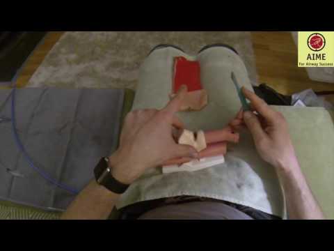 Fireside Bougie Cricothyrotomy: