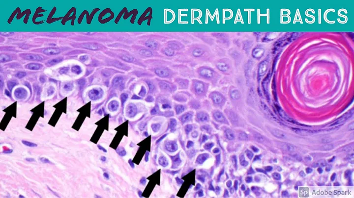 Melanoma vs Nevus: Microscopic Clues for Malignanc...