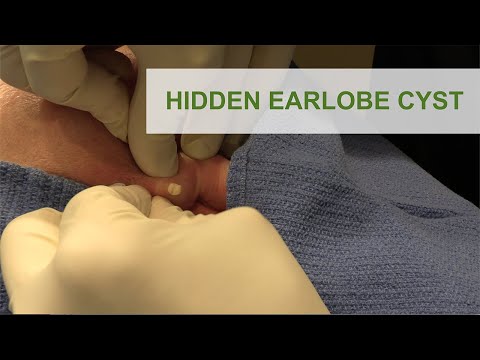 Hidden Earlobe Cyst | Dr. Derm