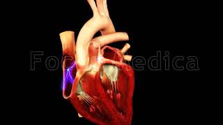 Episode onset - The Animated Atlas of Atrial Fibrillation