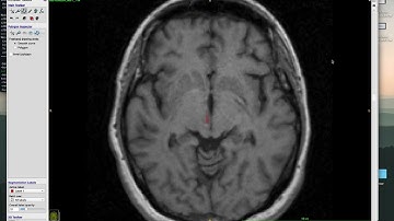 ITK-SNAP Tutorial: How to trace stroke lesions in T1w images