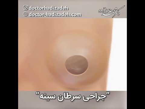 انیمیشن جراحی سرطان سینه دکتر هادیزاده    