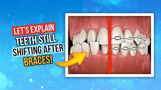 Why Do Teeth Shift After Braces?