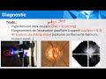 Conftube ECNi #35 -Glaucome chronique - Cours