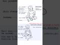 PEM (kwashiorkor and marasmus)