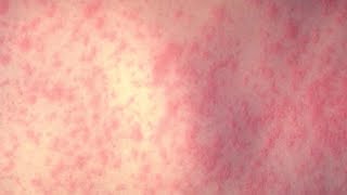Measles case confirmed in Georgia Net Worth