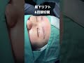 【閲覧注意】眉下リフト&目頭切開の術直後。丁寧に仕上げをします☆