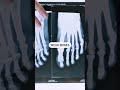5 symptoms of calcium deficiency 🦴✅ #bonehealth #calcium #deficiency #symptoms #health #shorts