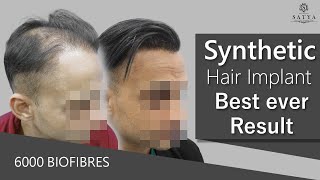 Bio Synthetic Hair Transplant Price In Delhi India  Cost of ArtificialBiofibre  Synthetic