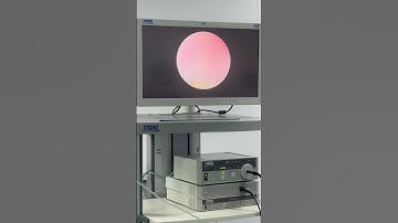 Sỏi niệu quản xuống bàng quang rồi mà ko ra được🥰 #Soithan #tansoithan  #bacsitung #pcnl #aroretic