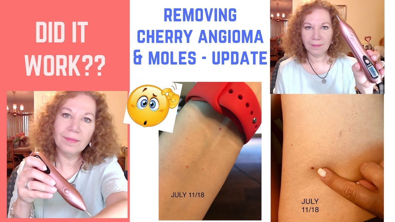 Cherry Angioma On Lip Removal Cherry Angioma Removal Total Body 