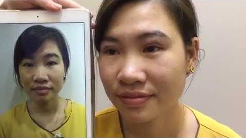 [Trực Tiếp] Tạo Mắt 2 Mí Bằng Công Nghệ Cắt Mí Mani Mini Deep - VTM Dr.Hải Lê